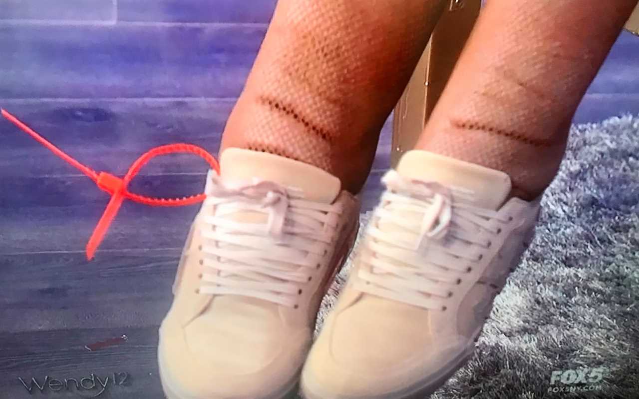 Wendy Williams showed viewers a close-up of her severely swollen ankles as she suffers from lymphedema