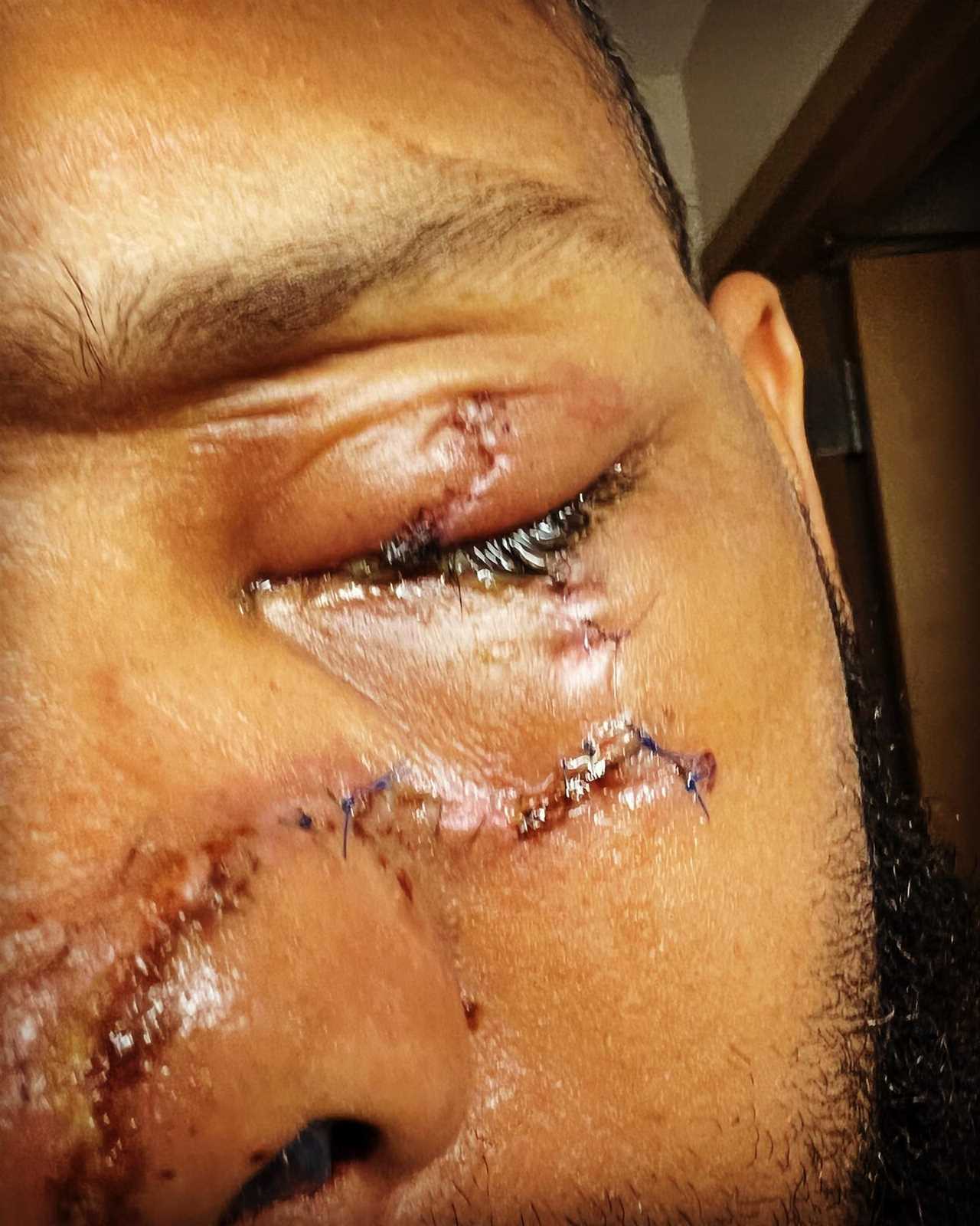 Top Chef’s Justin Sutherland shares terrifying photo of severe facial injury after he fell off a boat INTO a propeller