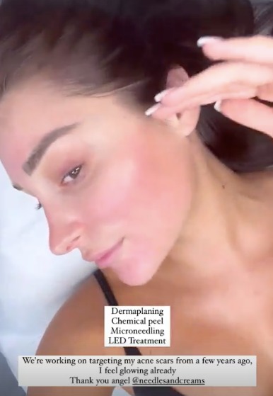 Love Island’s Coco Lodge reveals red sore face after undergoing chemical peel to get rid of acne scars