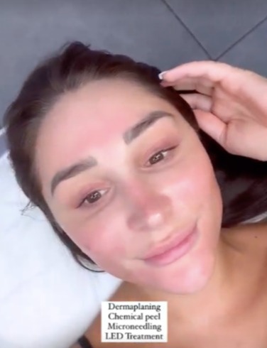 Love Island’s Coco Lodge reveals red sore face after undergoing chemical peel to get rid of acne scars