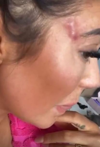 Geordie Shore’s Chloe Ferry shows off botched surgery scars after undergoing ‘fox eye’ op