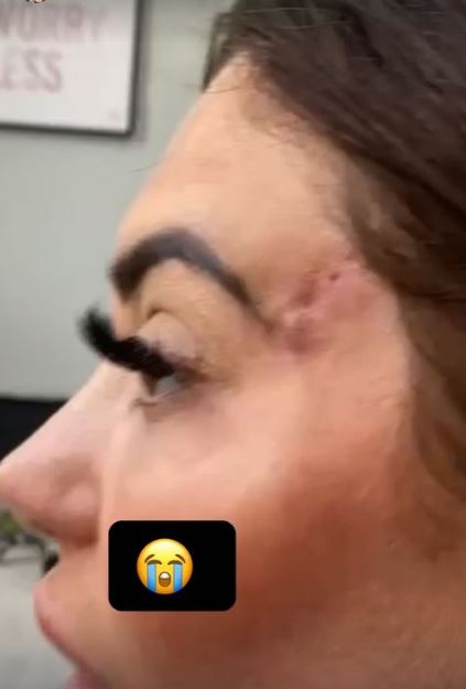 Geordie Shore’s Chloe Ferry shows off botched surgery scars after undergoing ‘fox eye’ op