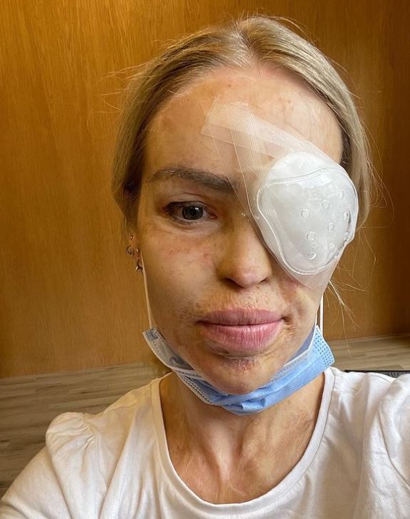 Katie Piper returns to Loose Women after major surgery, revealing tissue from donor was used to fix ‘hole’ in her eye