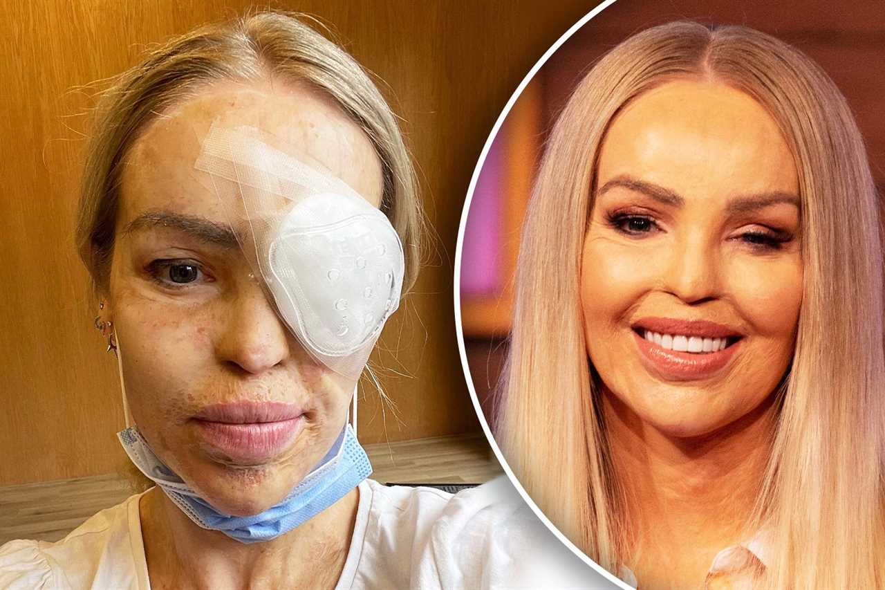 Katie Piper returns to Loose Women after major surgery, revealing tissue from donor was used to fix ‘hole’ in her eye