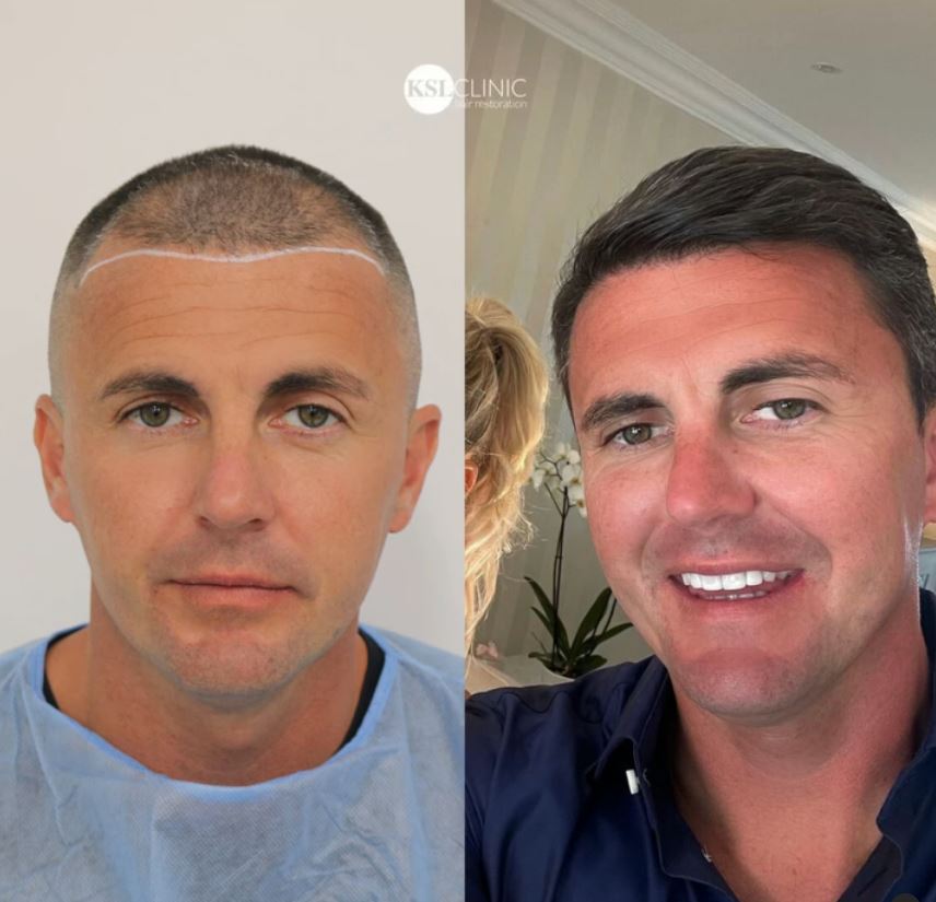 Billie Faiers’ husband Greg Shepherd shows off results of hair transplant in before and after pics