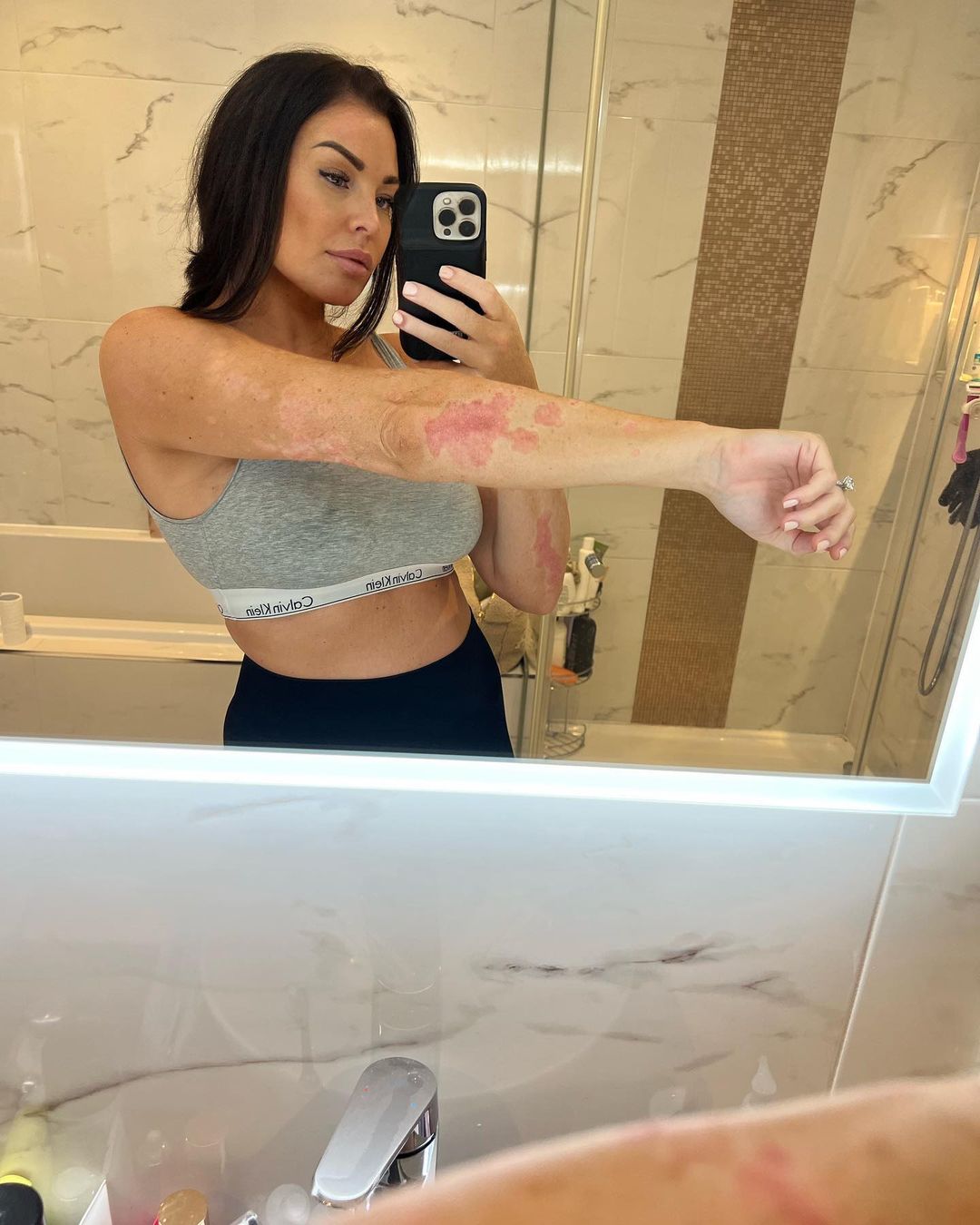 The reality favourite revealed her struggles with psoriasis