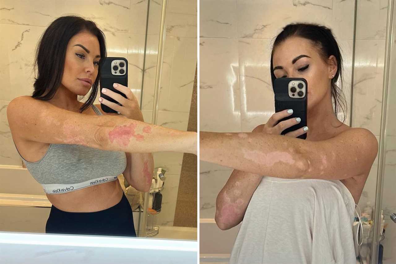 Jess Wright reveals ‘ugly’ battle with psoriasis after begging fans for a ‘miracle cure’