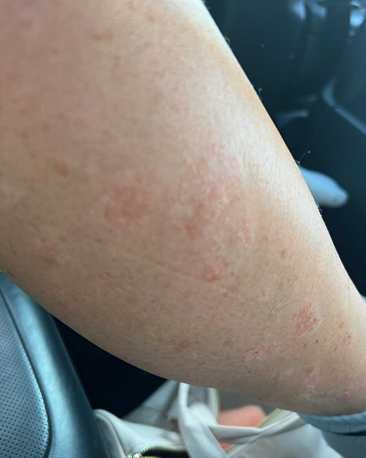 Jess Wright reveals ‘ugly’ battle with psoriasis after begging fans for a ‘miracle cure’