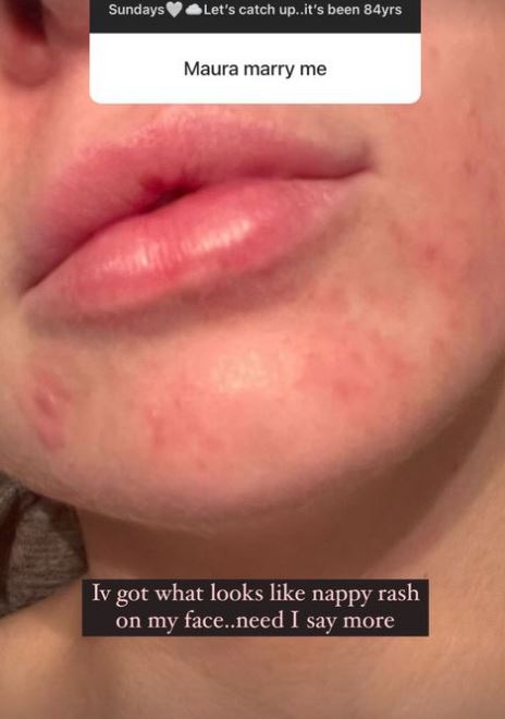Maura Higgins forced to get medical help as she reveals painful rash on face