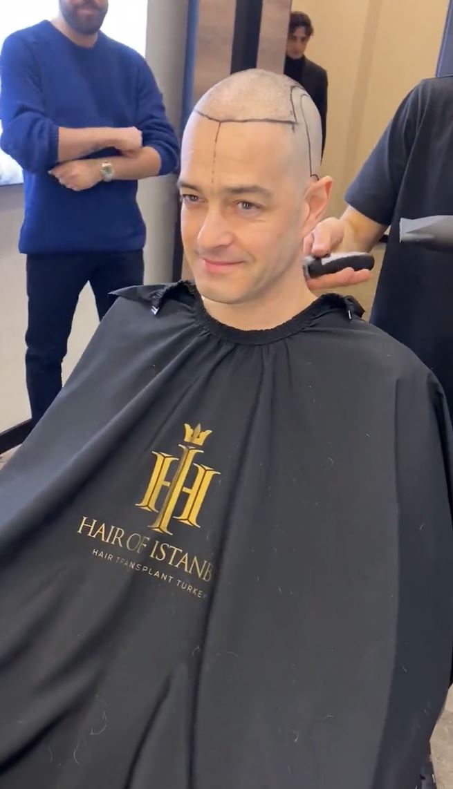 Pop singer looks unrecognisable as he shaves off famous curls before having hair transplant