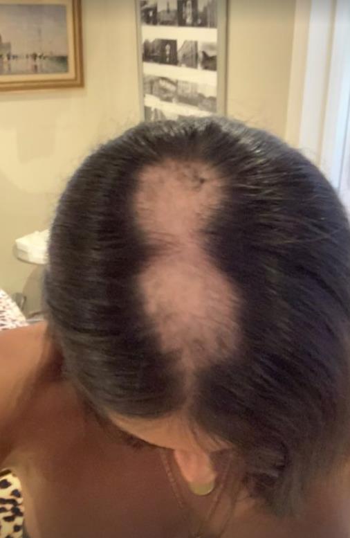 Love Island’s Layla reveals pictures of shocking hair loss as she tells fans she has alopecia