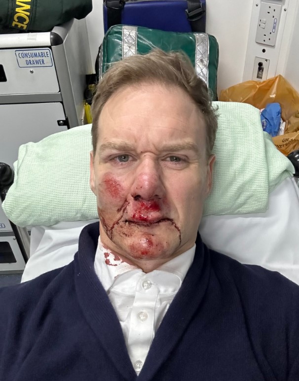 Dan Walker fans all say the same thing as he shows off bruises and puffy lip two weeks after horror cycling accident
