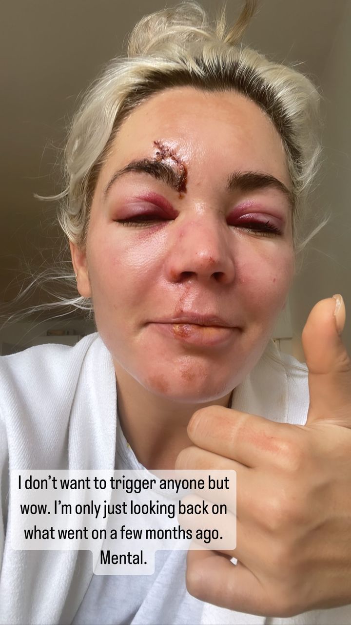 Danni Menzies reveals she’s still suffering from vertigo six months after horror moped smash