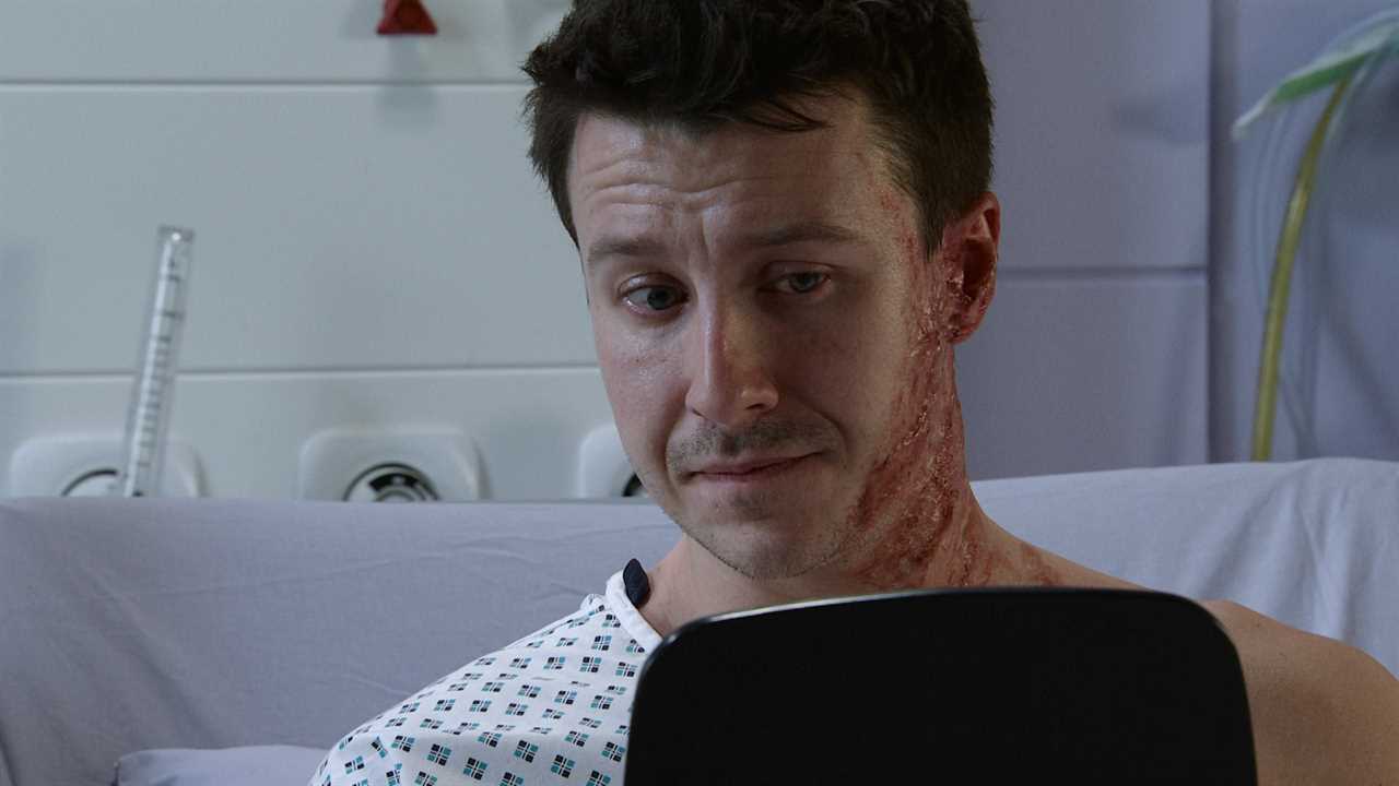 Coronation Street brings in Hollywood experts for Ryan Connor’s grisly acid attack injuries