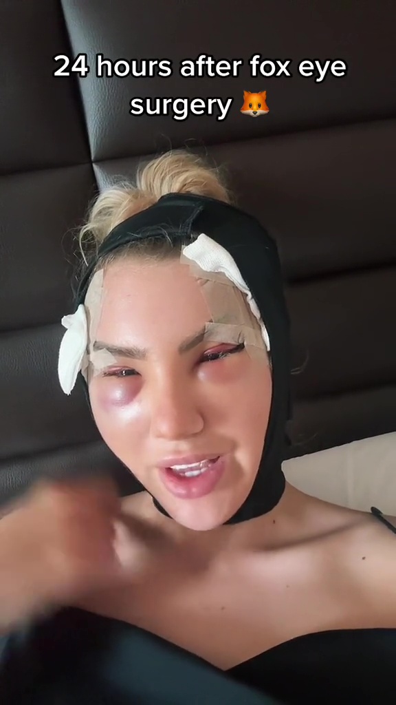 Love Island star unrecognisable as she shows off ‘new face’ after controversial fox eye surgery