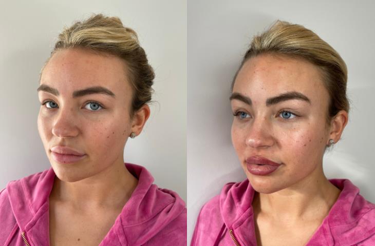 Towie’s Ella Rae Wise shows off results of her £600 lipstick tattoo after getting lip filler dissolved