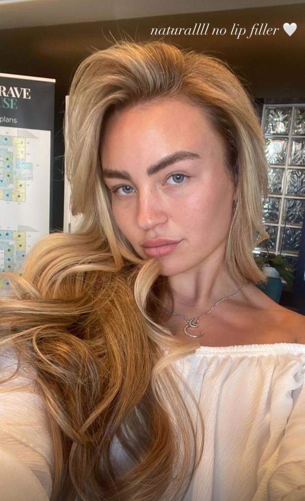 Towie’s Ella Rae Wise shows off results of her £600 lipstick tattoo after getting lip filler dissolved