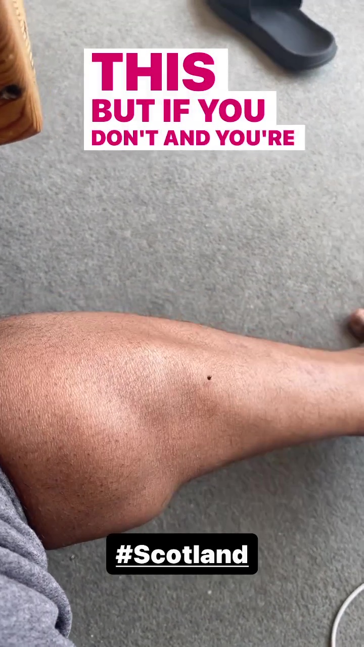 Strictly’s Hamza Yassin issues terrifying warning after nasty bug that causes ‘brain swelling’ gets stuck in his leg