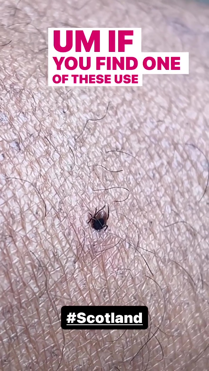 Strictly’s Hamza Yassin issues terrifying warning after nasty bug that causes ‘brain swelling’ gets stuck in his leg