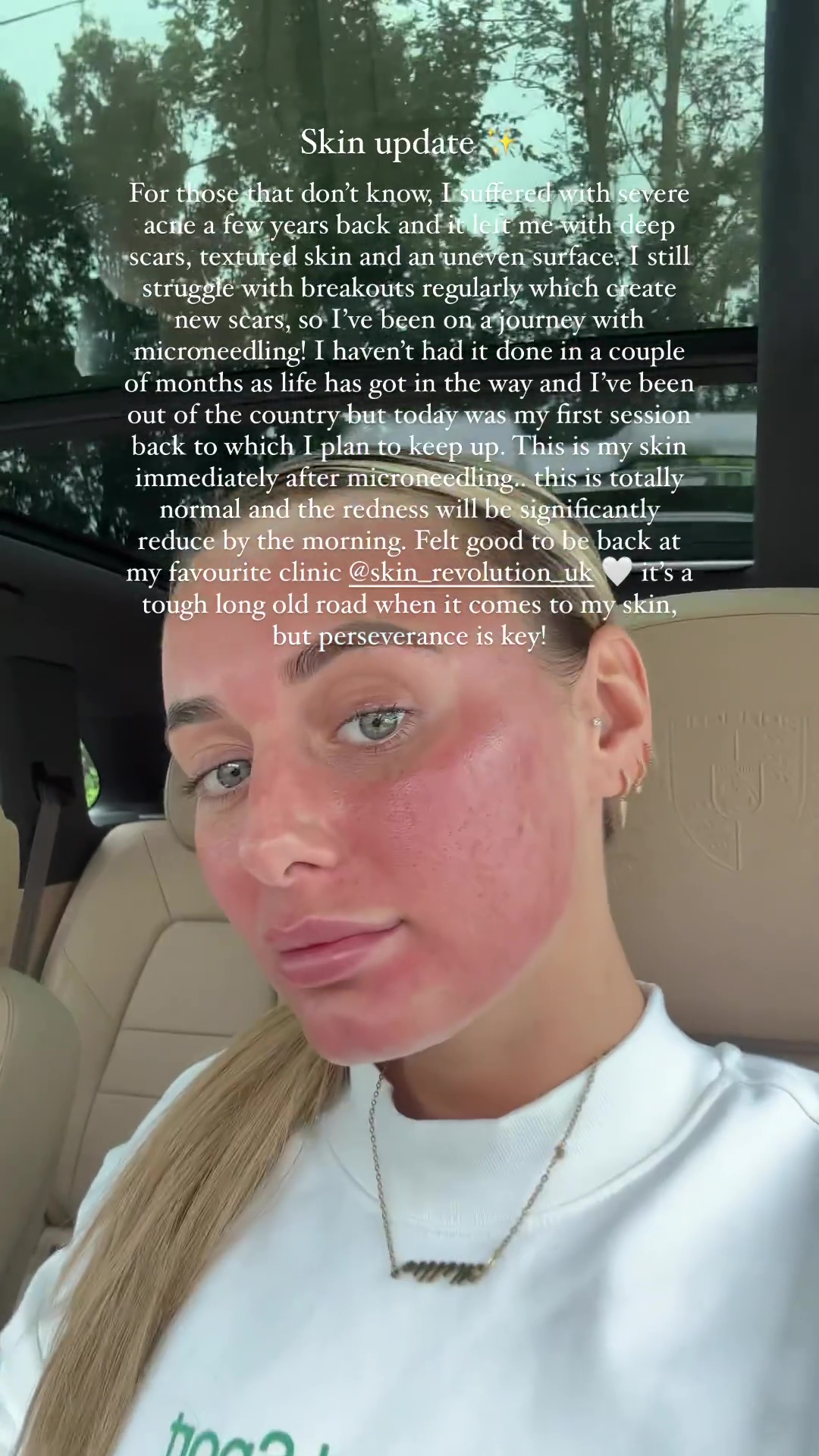 Love Island’s Millie Court reveals her ‘real’ skin after decade-long battle with acne