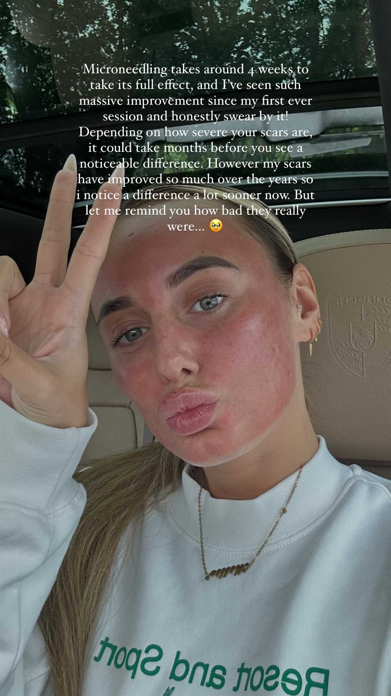 Love Island’s Millie Court reveals her ‘real’ skin after decade-long battle with acne