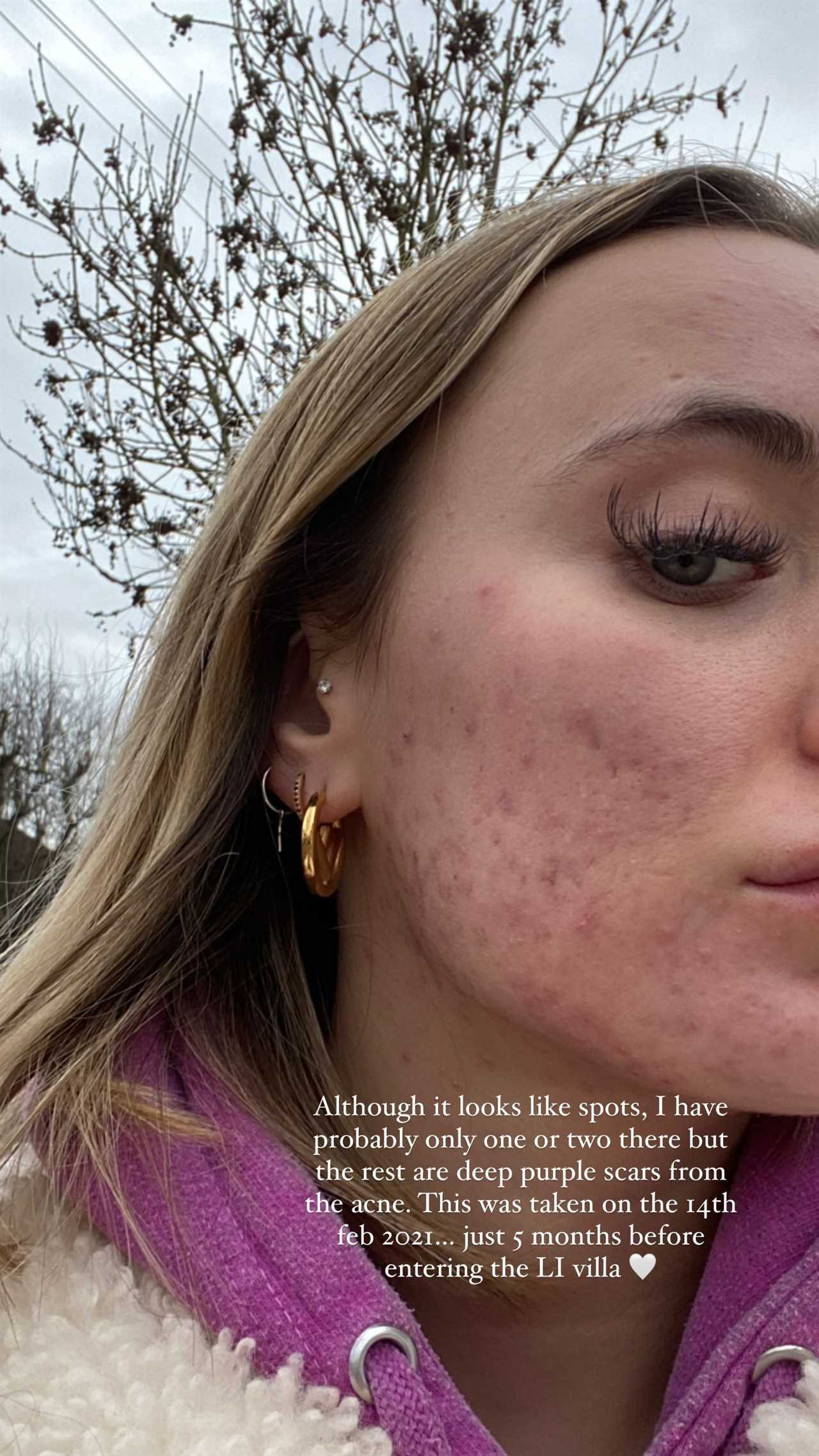 Love Island’s Millie Court reveals her ‘real’ skin after decade-long battle with acne