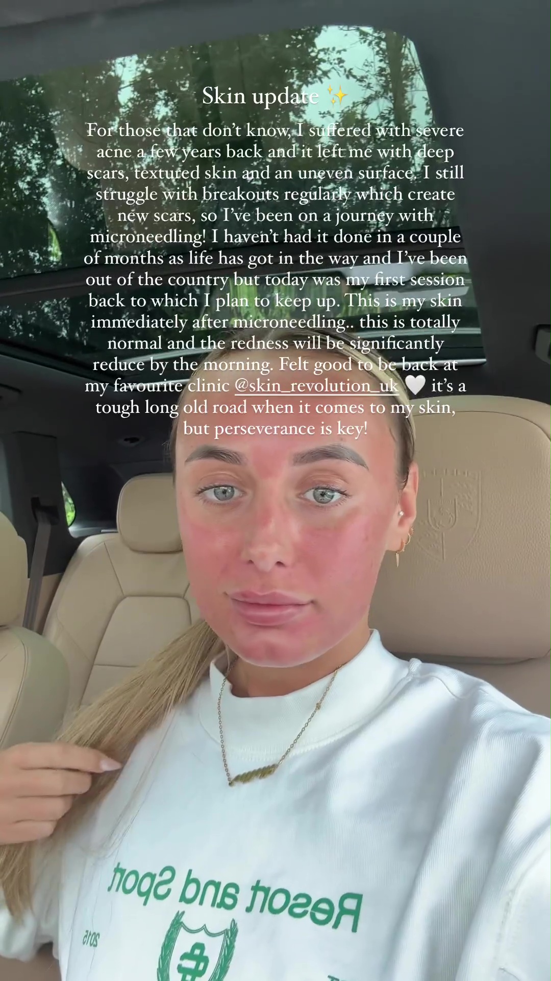 Love Island’s Millie Court reveals her ‘real’ skin after decade-long battle with acne