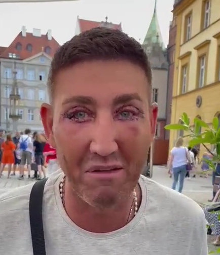 X Factor Star Christopher Maloney Reveals Bruised Eyes Following Eyelid Surgery in Poland