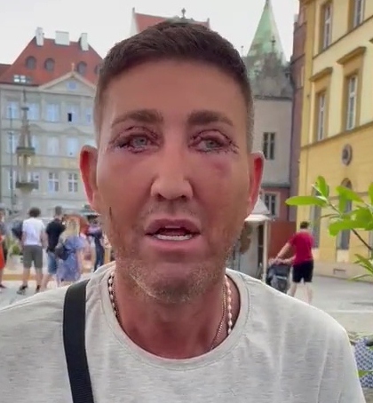 X Factor Star Christopher Maloney Reveals Bruised Eyes Following Eyelid Surgery in Poland