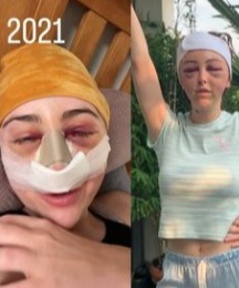 MAFS UK Star Ella Morgan Shares Throwback Snaps After Facial Surgery