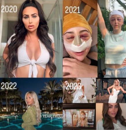 MAFS UK Star Ella Morgan Shares Throwback Snaps After Facial Surgery