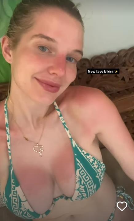 Helen Flanagan's Sunburnt Chest Sparks Concern Among Fans