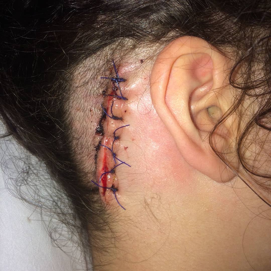 The Traitors Star Charlotte Reveals Massive Scar from Emergency Brain Surgery Ahead of Show