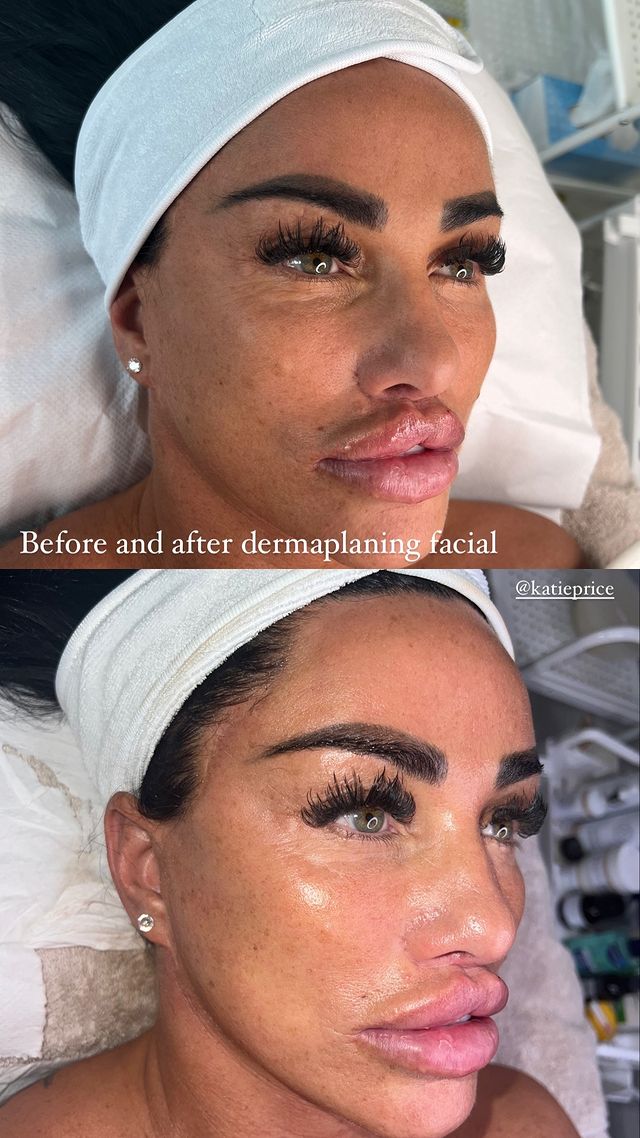 Katie Price flaunts her fuller lips post age-defying facial treatment