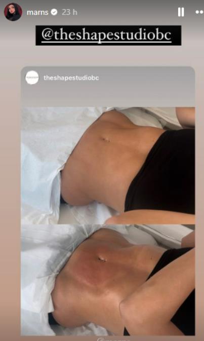 Geordie Shore Star Reveals Tummy Transformation After Body Contouring Procedure