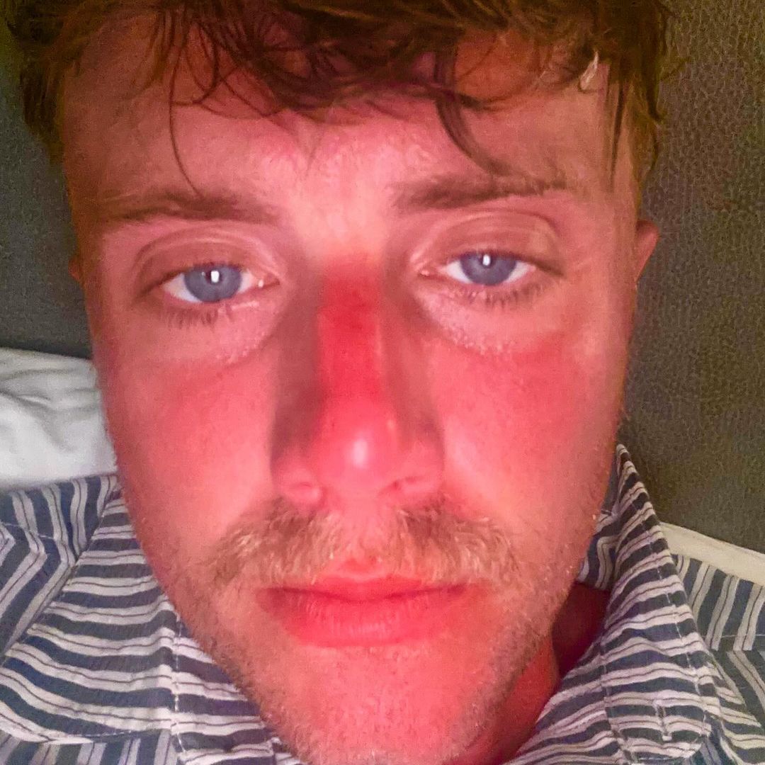 Roman Kemp's Sunburn Sparks Concern