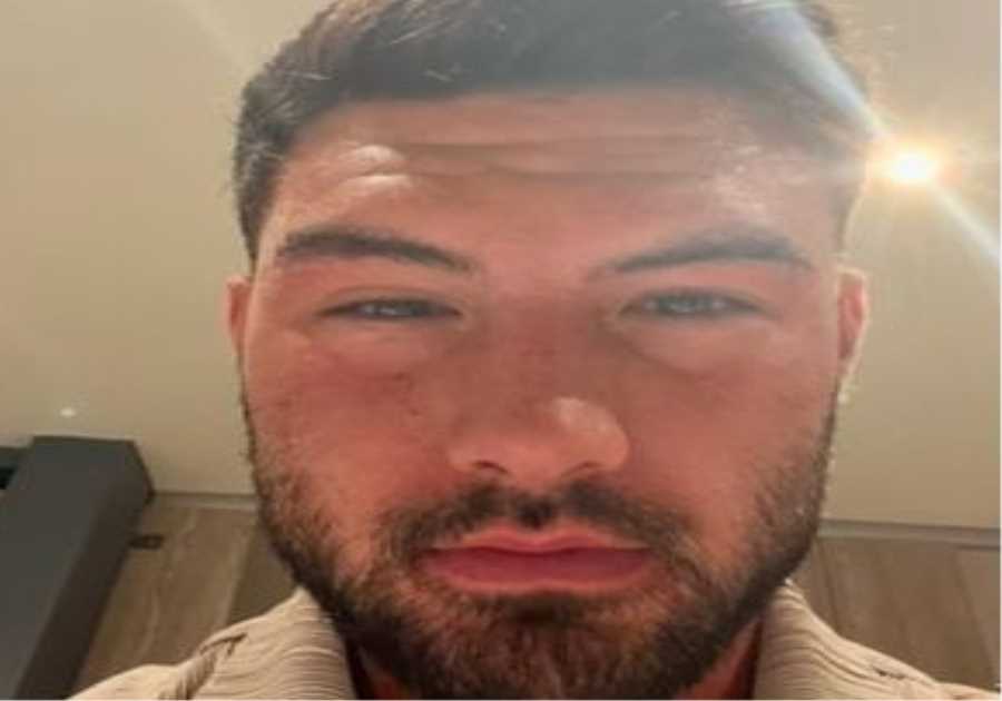 Love Island winner Liam Reardon shares shocking photo of swollen face after food poisoning nightmare