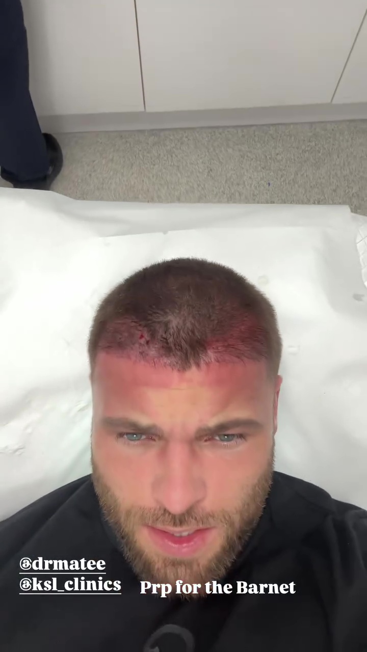 Former Love Island Star Reveals Painful Procedure to Prevent Hair Loss