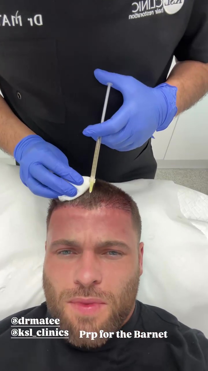 Former Love Island Star Reveals Painful Procedure to Prevent Hair Loss