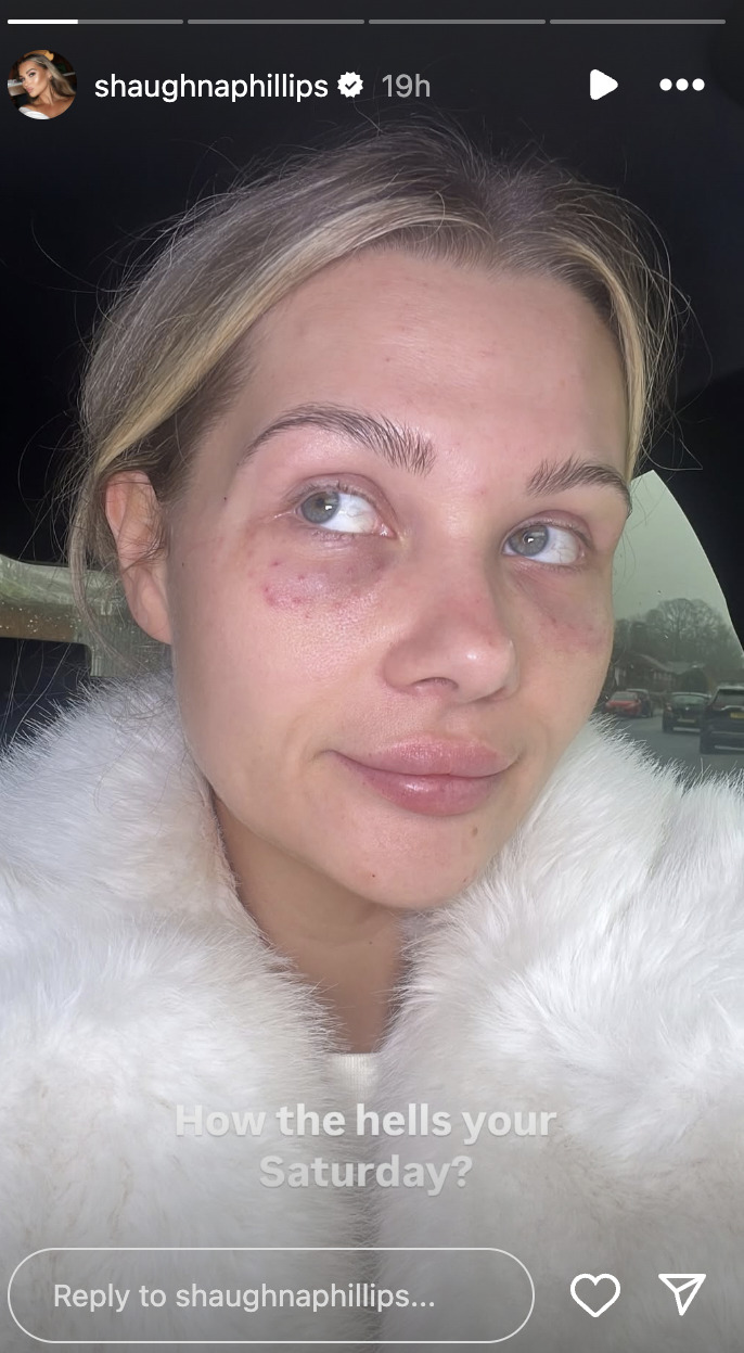 Love Island's Shaughna Phillips Sparks Concerns with Bruised Face