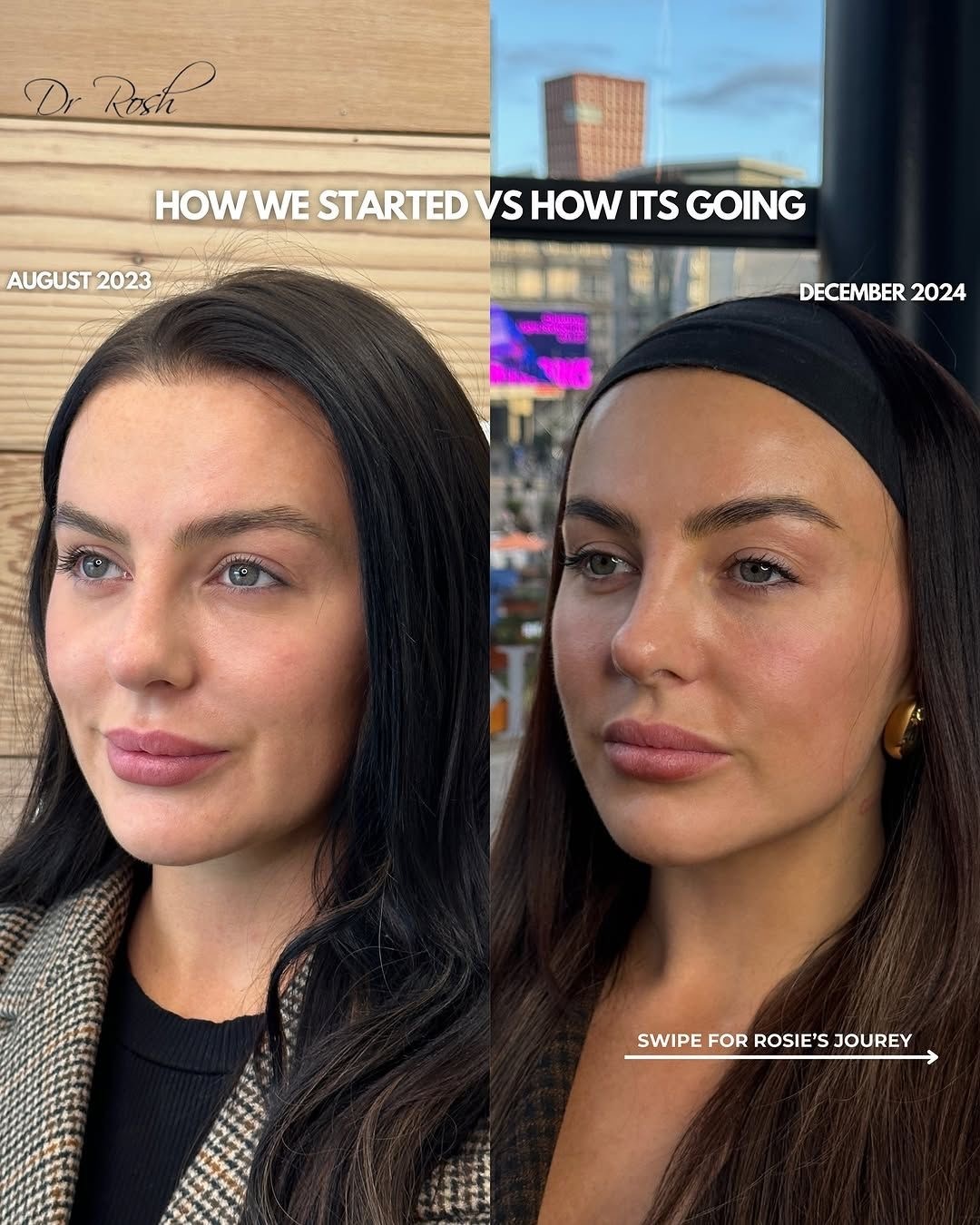 Love Island's Rosie Williams Unveils Stunning New Look After Dissolving Fillers