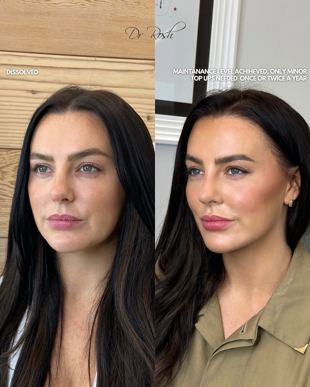 Love Island's Rosie Williams Unveils Stunning New Look After Dissolving Fillers