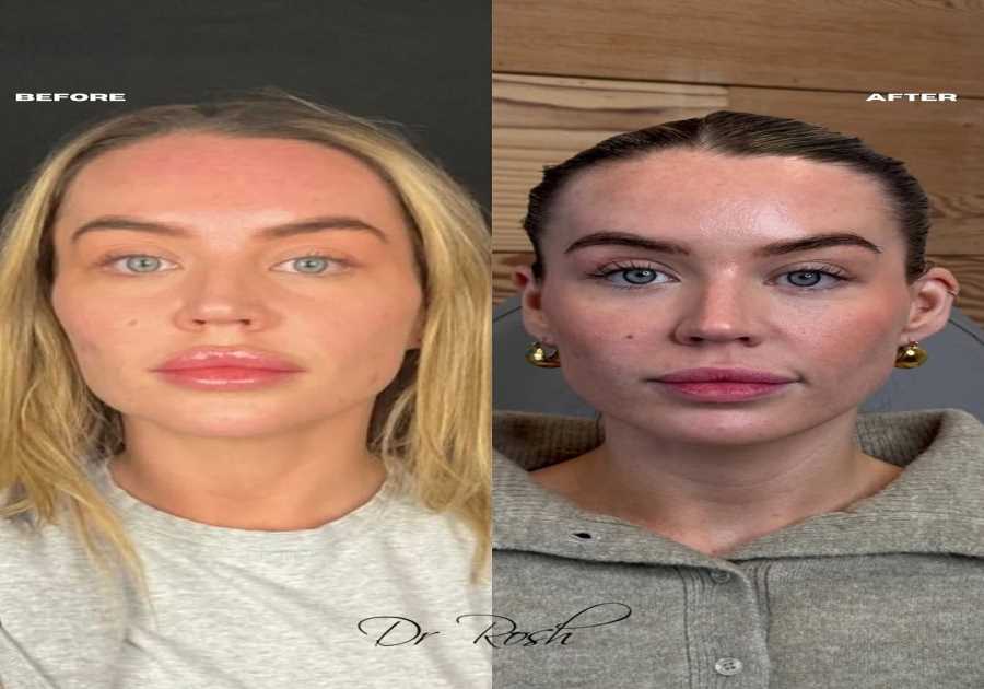 Love Island's Samantha Kenny reveals face transformation after reversing unnatural look