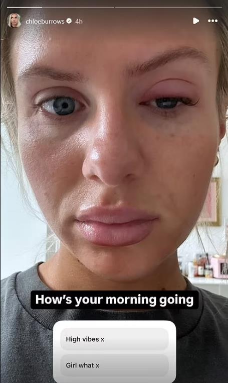 Chloe Burrows' Eye Condition Prompts Concern Among Fans: A Deeper Look