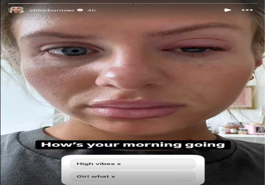Chloe Burrows' Eye Condition Prompts Concern Among Fans: A Deeper Look