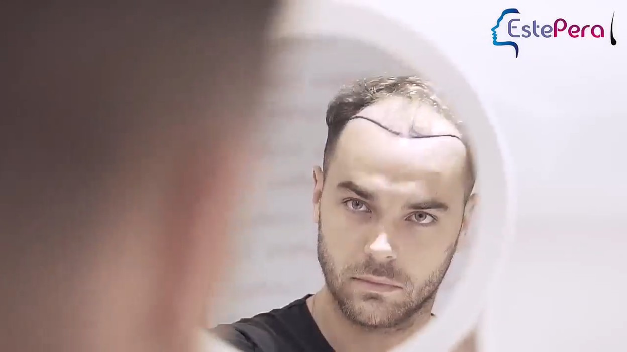Analysis: Love Island Star's Hair Transplant at 24 Sparks Debate on Beauty Standards